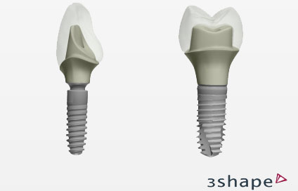 2-piece customized abutments